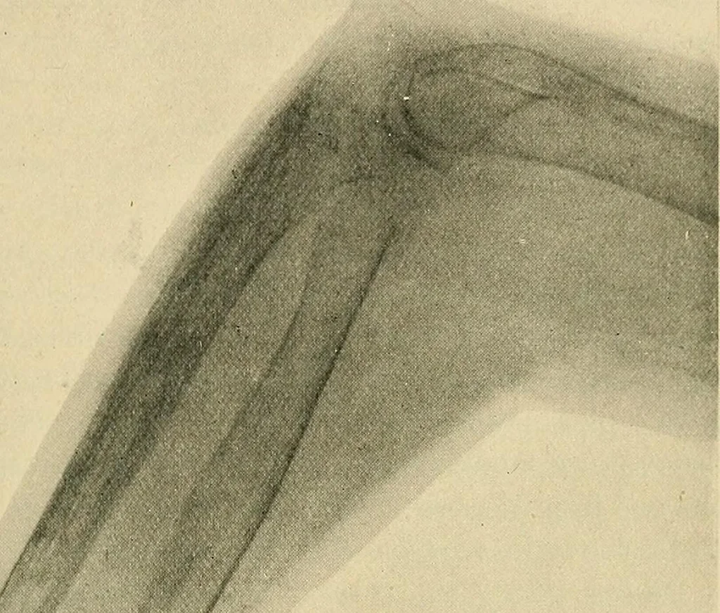 An illustration from The Röntgen rays in medical work, 1907, leaf 226
