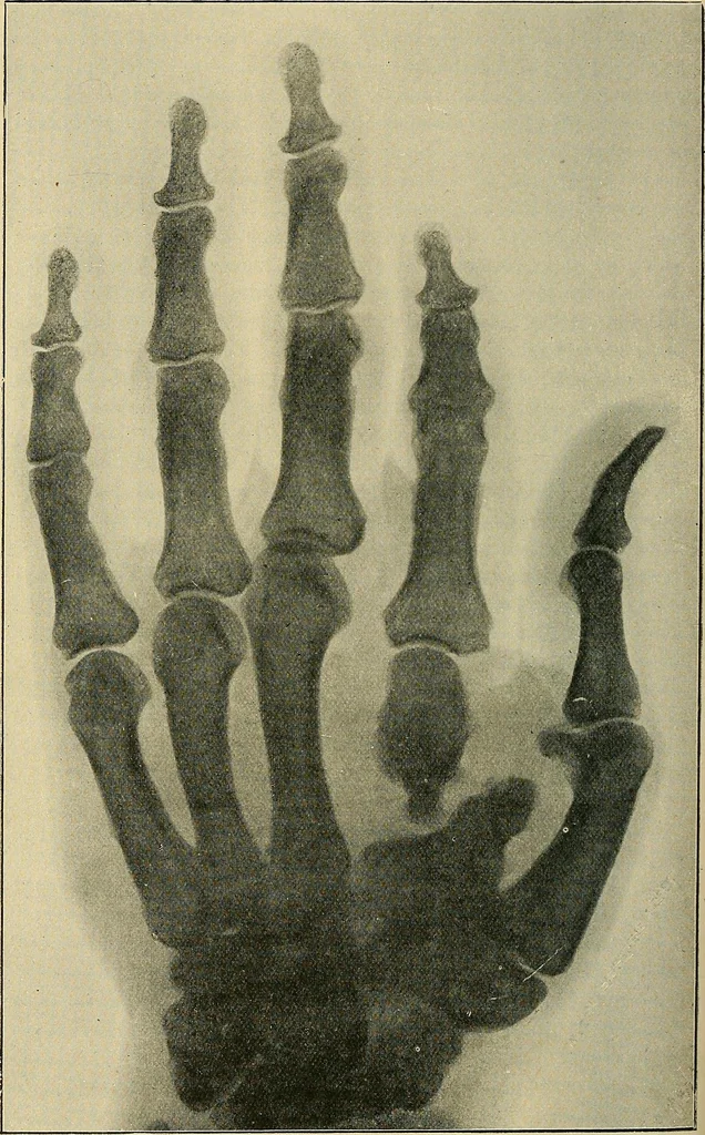 An illustration from The Röntgen rays in medical work, 1907, leaf 229