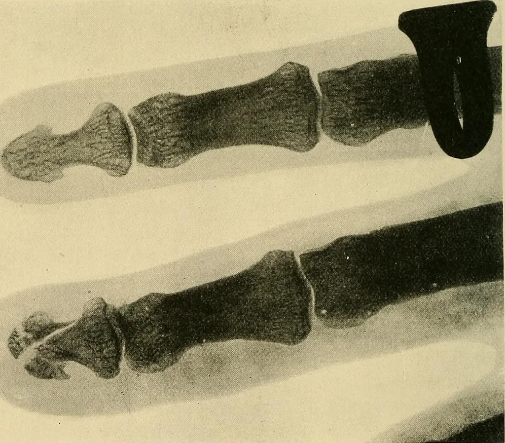 An illustration from The Röntgen rays in medical work, 1907, leaf 233