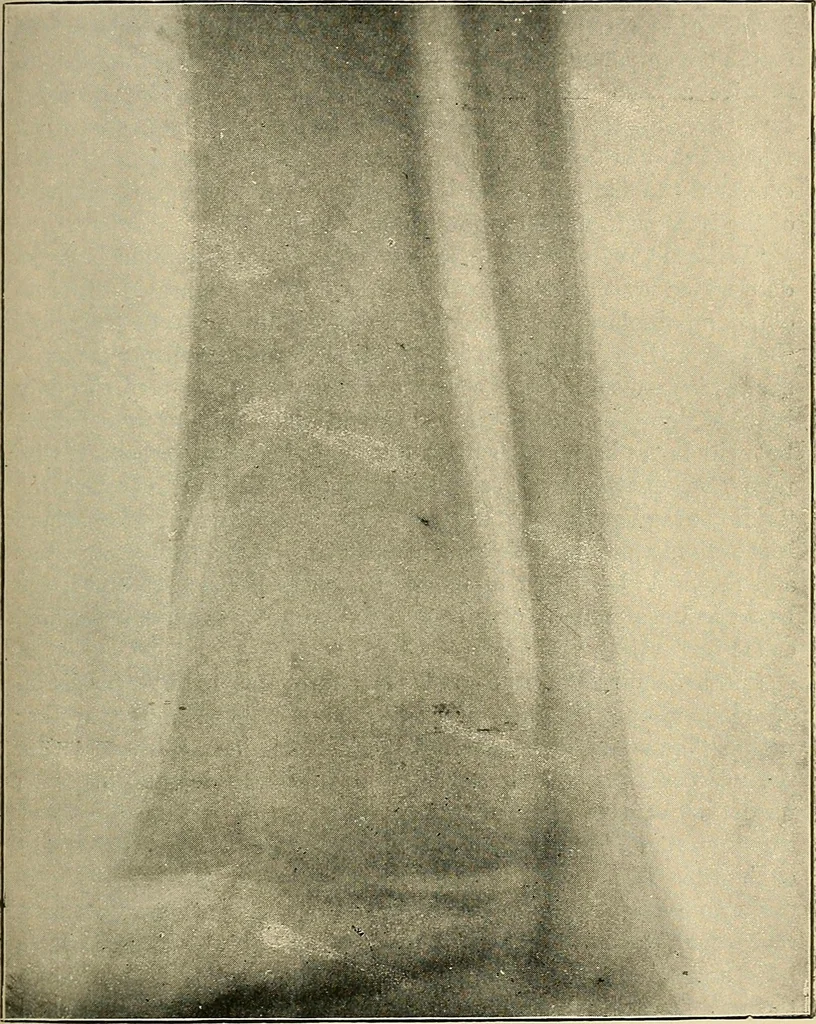 An illustration from The Röntgen rays in medical work, 1907, leaf 240