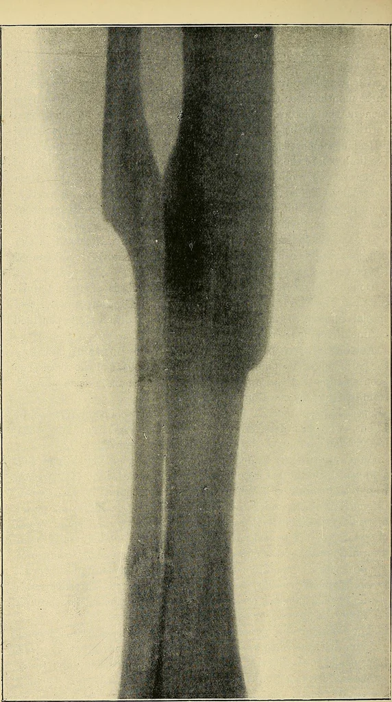 An illustration from The Röntgen rays in medical work, 1907, leaf 243