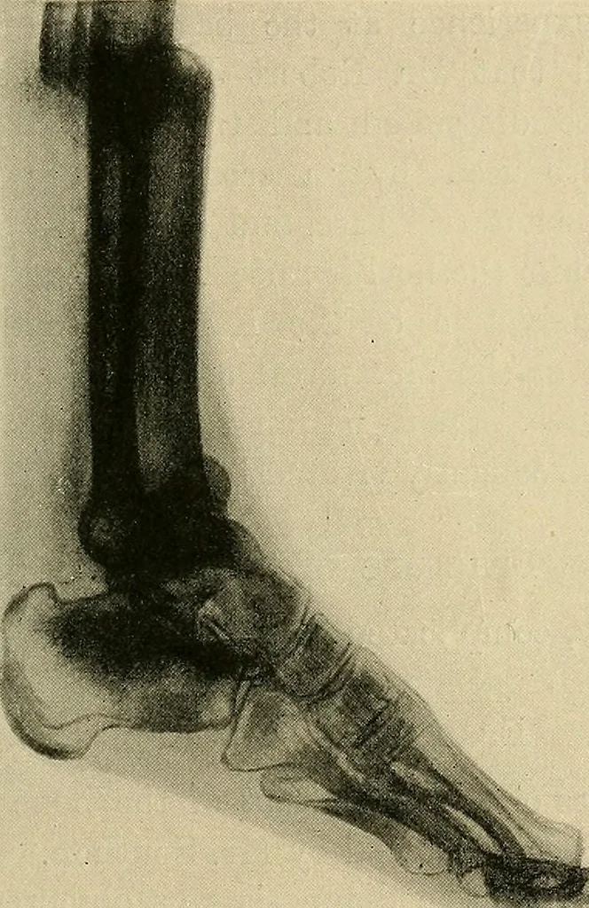 An illustration from The Röntgen rays in medical work, 1907, leaf 244