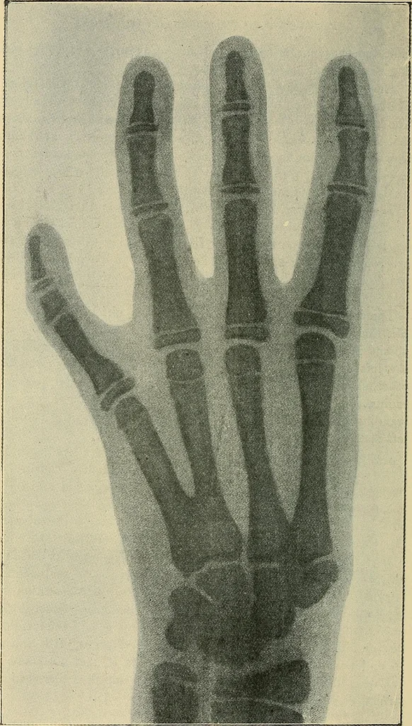 An illustration from The Röntgen rays in medical work, 1907, leaf 271