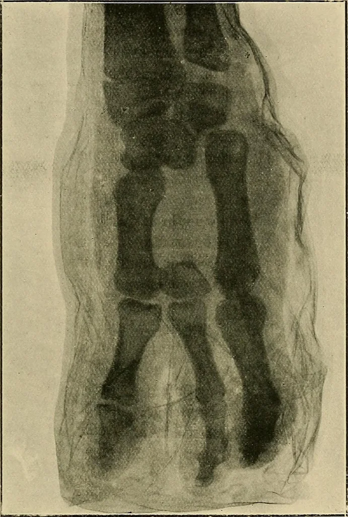 An illustration from The Röntgen rays in medical work, 1907, leaf 272