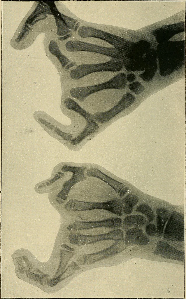 An illustration from The Röntgen rays in medical work, 1907, leaf 273