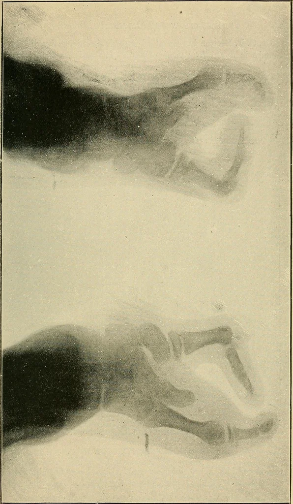 An illustration from The Röntgen rays in medical work, 1907, leaf 274