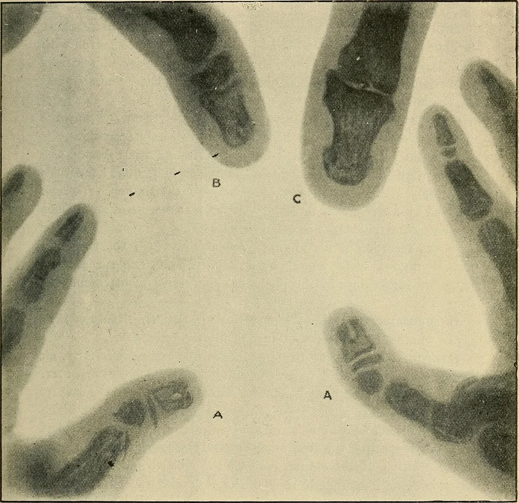 An illustration from The Röntgen rays in medical work, 1907, leaf 276