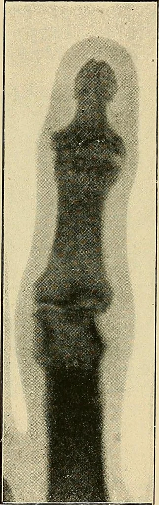 An illustration from The Röntgen rays in medical work, 1907, leaf 292