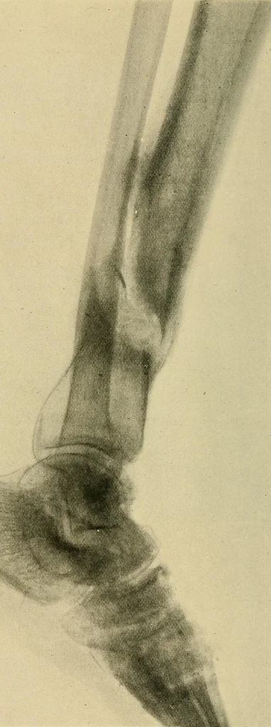 An illustration from The Röntgen rays in medical work, 1907, leaf 295