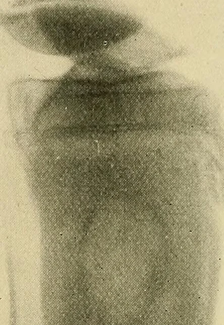 An illustration from The Röntgen rays in medical work, 1907, leaf 303