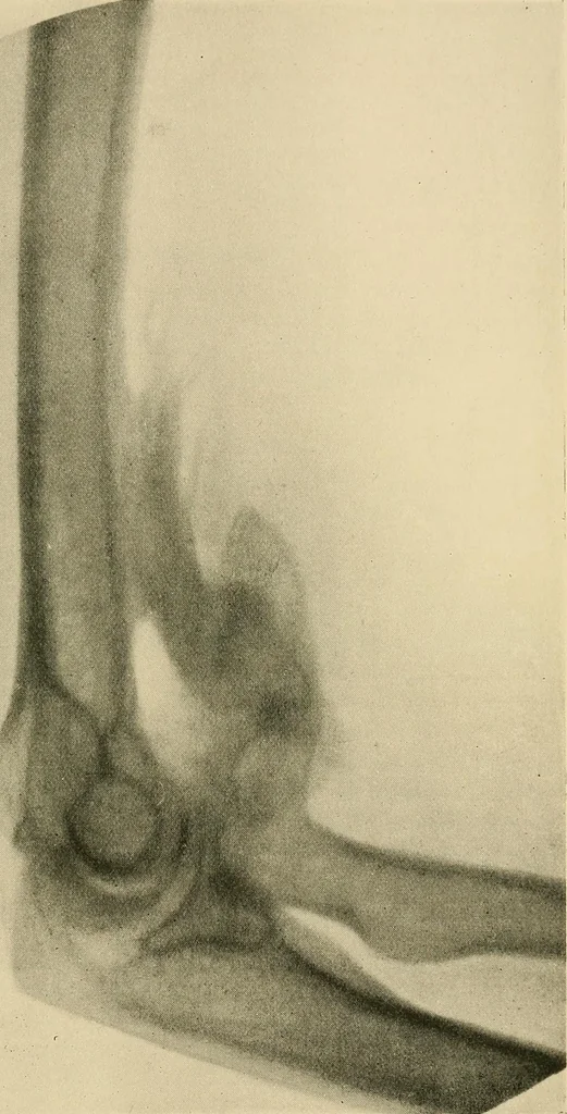 An illustration from The Röntgen rays in medical work, 1907, leaf 310