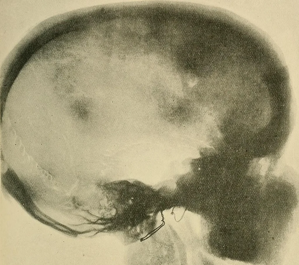 An illustration from The Röntgen rays in medical work, 1907, leaf 314