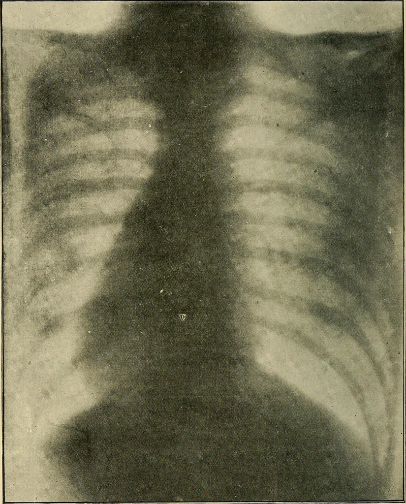 An illustration from The Röntgen rays in medical work, 1907, leaf 343