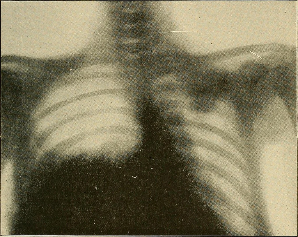 An illustration from The Röntgen rays in medical work, 1907, leaf 362