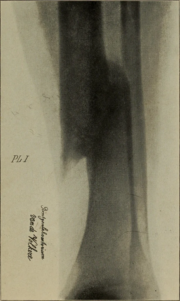 An illustration from Röntgentechniek : therapeutische beteekenis der "X" -stralen en der stoomen van hooge fréquentie, 1904, leaf 14