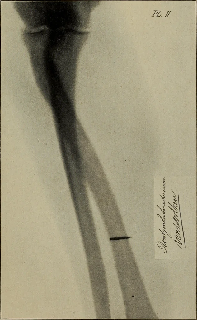 An illustration from Röntgentechniek : therapeutische beteekenis der "X" -stralen en der stoomen van hooge fréquentie, 1904, leaf 16