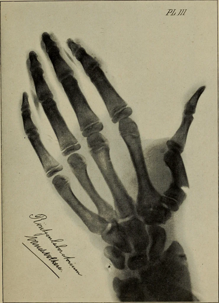 An illustration from Röntgentechniek : therapeutische beteekenis der "X" -stralen en der stoomen van hooge fréquentie, 1904, leaf 18