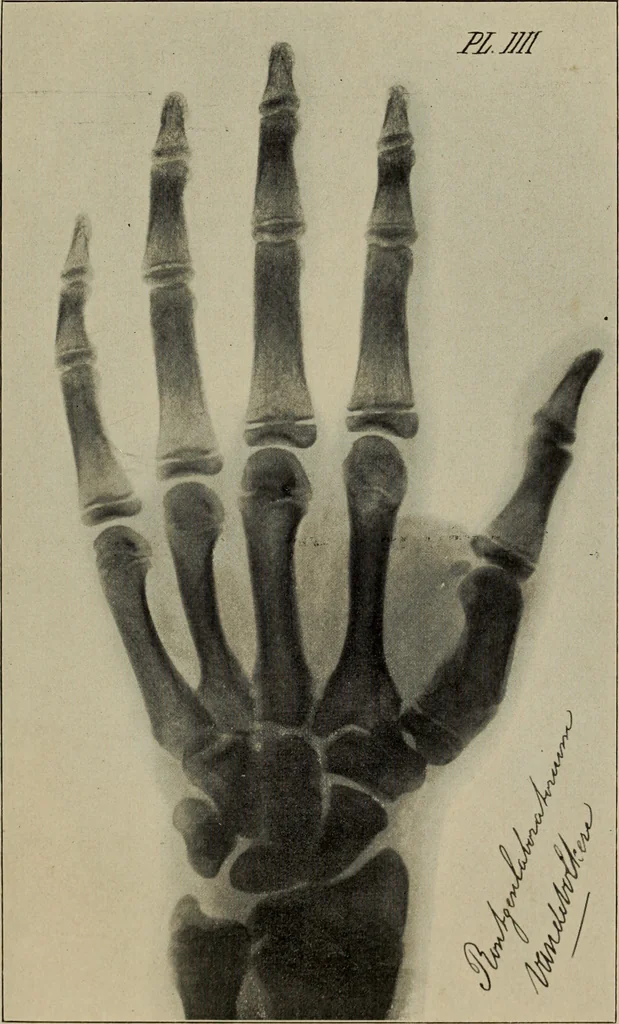An illustration from Röntgentechniek : therapeutische beteekenis der "X" -stralen en der stoomen van hooge fréquentie, 1904, leaf 20