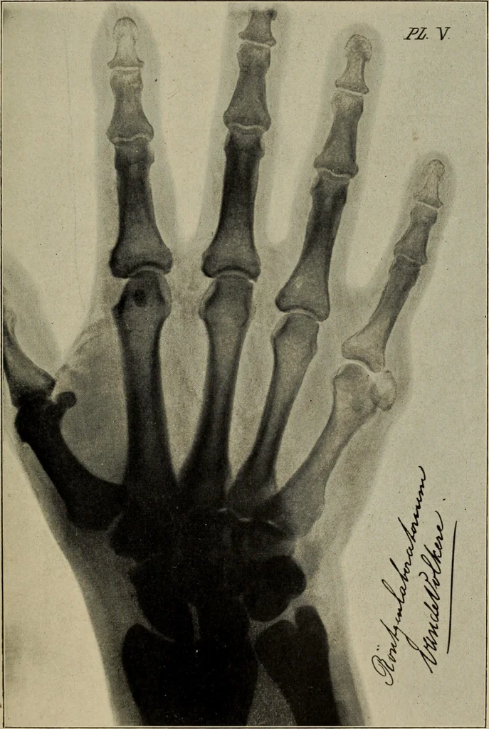 An illustration from Röntgentechniek : therapeutische beteekenis der "X" -stralen en der stoomen van hooge fréquentie, 1904, leaf 22