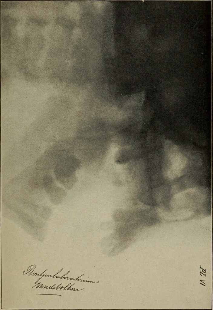An illustration from Röntgentechniek : therapeutische beteekenis der "X" -stralen en der stoomen van hooge fréquentie, 1904, leaf 24