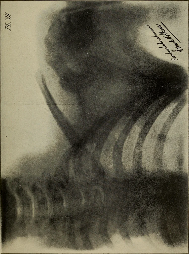 An illustration from Röntgentechniek : therapeutische beteekenis der "X" -stralen en der stoomen van hooge fréquentie, 1904, leaf 26