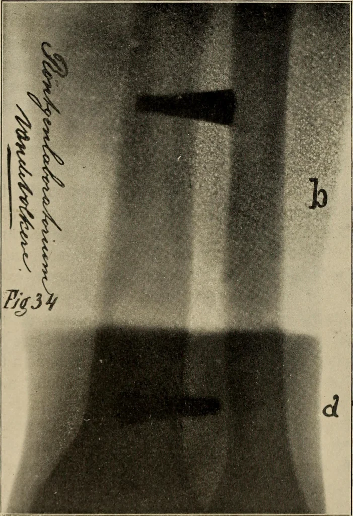 An illustration from Röntgentechniek : therapeutische beteekenis der "X" -stralen en der stoomen van hooge fréquentie, 1904, leaf 67