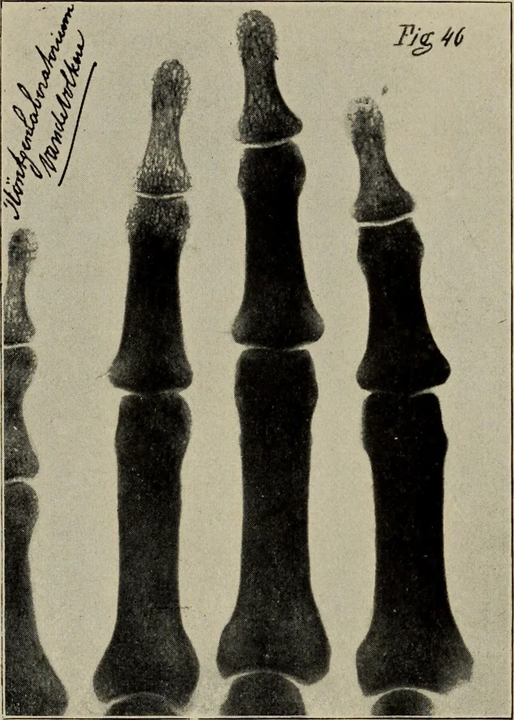 An illustration from Röntgentechniek : therapeutische beteekenis der "X" -stralen en der stoomen van hooge fréquentie, 1904, leaf 88