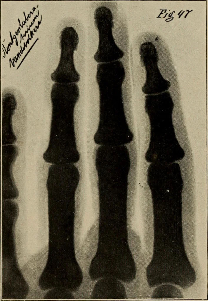 An illustration from Röntgentechniek : therapeutische beteekenis der "X" -stralen en der stoomen van hooge fréquentie, 1904, leaf 89