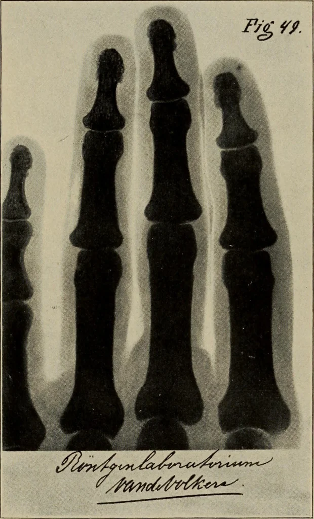 An illustration from Röntgentechniek : therapeutische beteekenis der "X" -stralen en der stoomen van hooge fréquentie, 1904, leaf 90