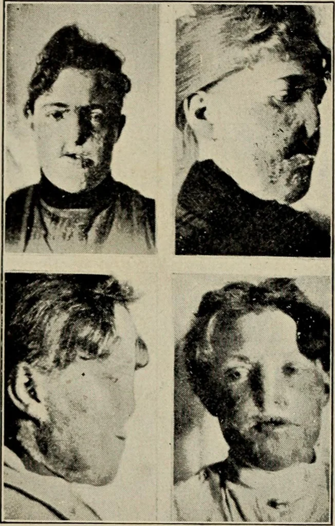 An illustration from Röntgentechniek : therapeutische beteekenis der "X" -stralen en der stoomen van hooge fréquentie, 1904, leaf 97