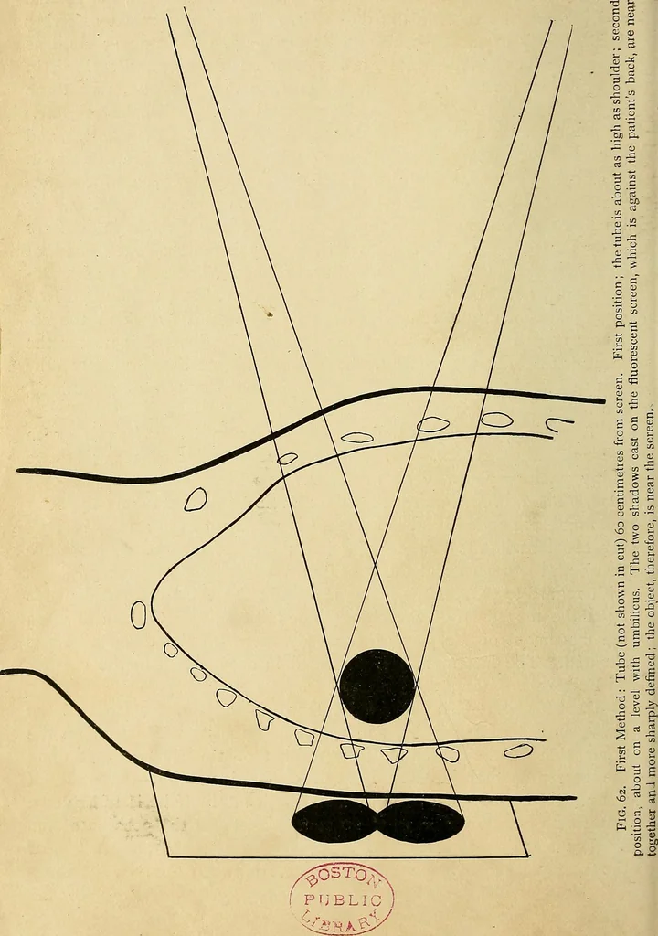 An illustration from The Roentgen rays in medicine and surgery as an aid in diagnosis and as a therapeutic agent : designed for the use of practitioners and students, 1901, leaf 113