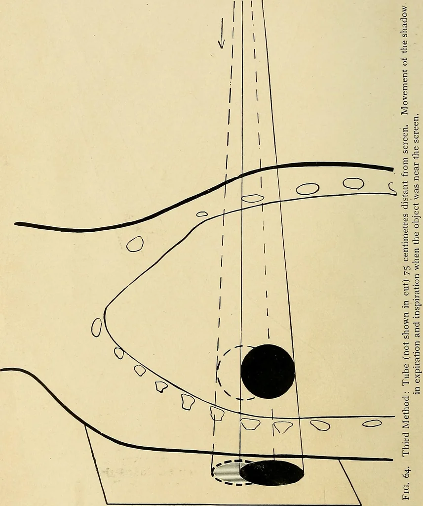 An illustration from The Roentgen rays in medicine and surgery as an aid in diagnosis and as a therapeutic agent : designed for the use of practitioners and students, 1901, leaf 115