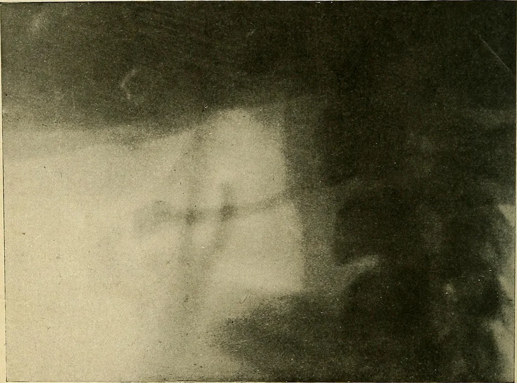 An illustration from The Roentgen rays in medicine and surgery as an aid in diagnosis and as a therapeutic agent : designed for the use of practitioners and students, 1901, leaf 119