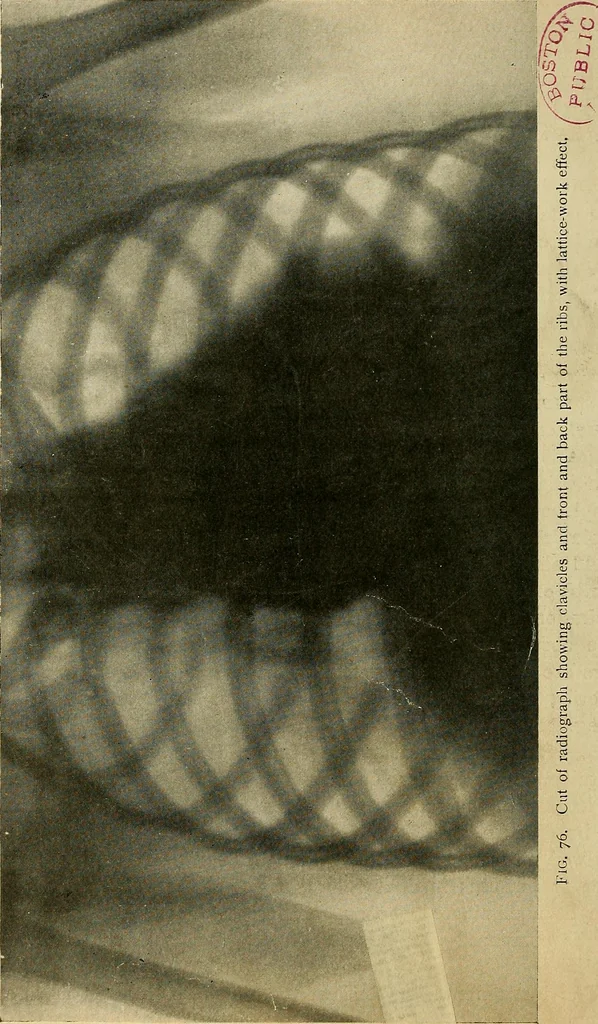 An illustration from The Roentgen rays in medicine and surgery as an aid in diagnosis and as a therapeutic agent : designed for the use of practitioners and students, 1901, leaf 133