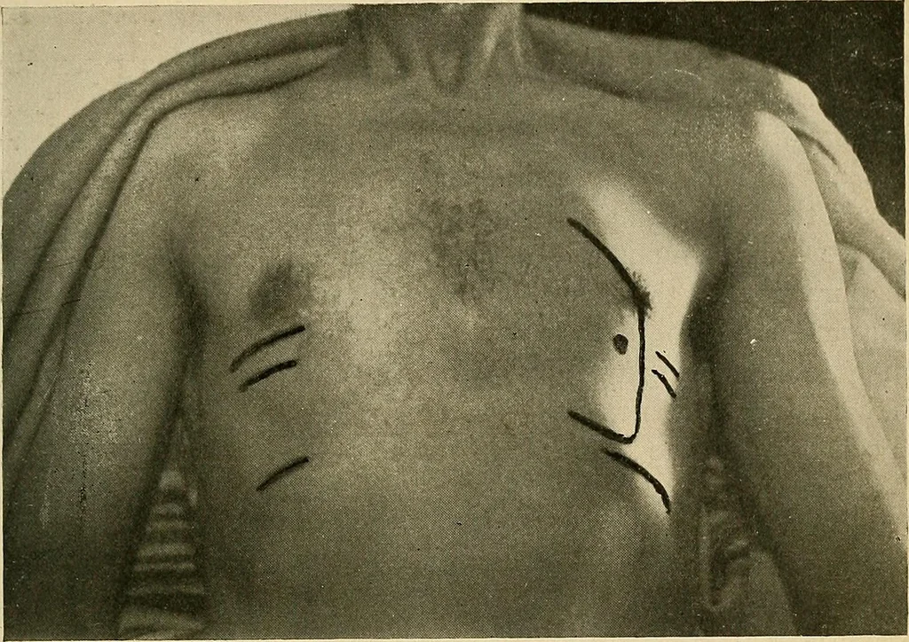 An illustration from The Roentgen rays in medicine and surgery as an aid in diagnosis and as a therapeutic agent : designed for the use of practitioners and students, 1901, leaf 136