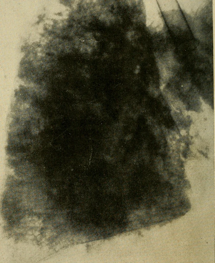 An illustration from The Roentgen rays in medicine and surgery as an aid in diagnosis and as a therapeutic agent : designed for the use of practitioners and students, 1901, leaf 141