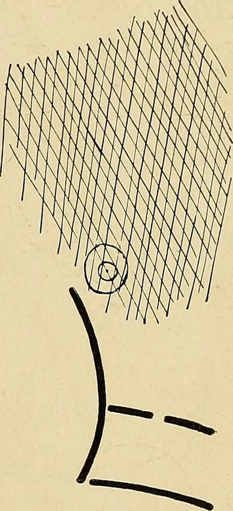 An illustration from The Roentgen rays in medicine and surgery as an aid in diagnosis and as a therapeutic agent : designed for the use of practitioners and students, 1901, leaf 178