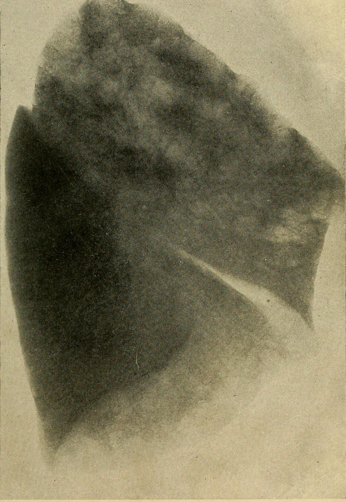 An illustration from The Roentgen rays in medicine and surgery as an aid in diagnosis and as a therapeutic agent : designed for the use of practitioners and students, 1901, leaf 192