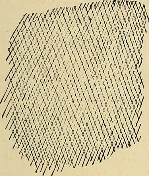 An illustration from The Roentgen rays in medicine and surgery as an aid in diagnosis and as a therapeutic agent : designed for the use of practitioners and students, 1901, leaf 212