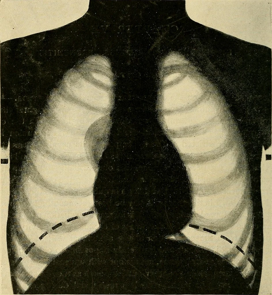 An illustration from The Roentgen rays in medicine and surgery as an aid in diagnosis and as a therapeutic agent : designed for the use of practitioners and students, 1901, leaf 219