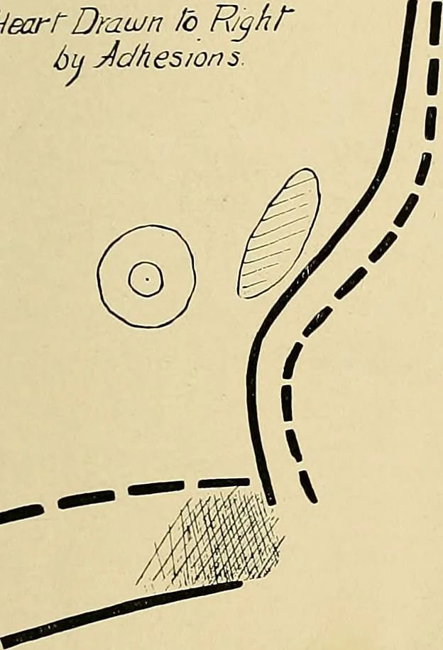 An illustration from The Roentgen rays in medicine and surgery as an aid in diagnosis and as a therapeutic agent : designed for the use of practitioners and students, 1901, leaf 312
