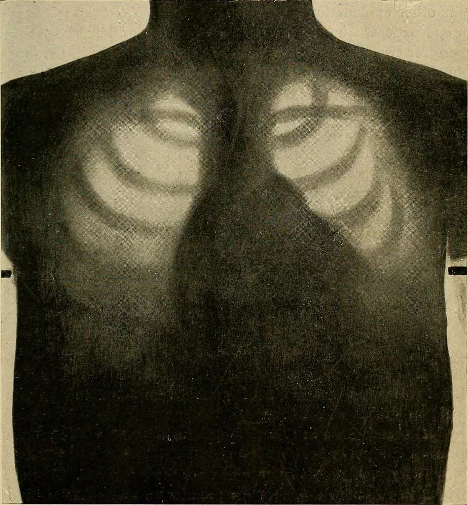 An illustration from The Roentgen rays in medicine and surgery as an aid in diagnosis and as a therapeutic agent : designed for the use of practitioners and students, 1901, leaf 326