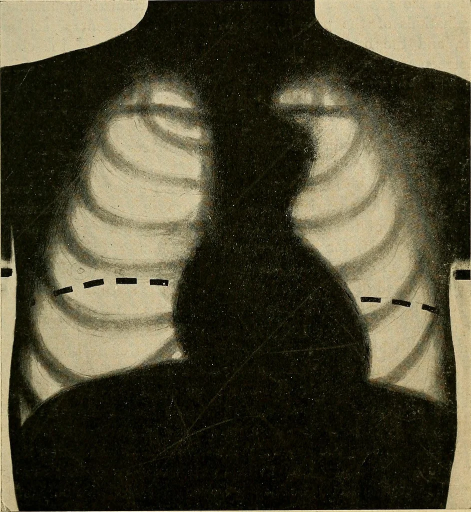 An illustration from The Roentgen rays in medicine and surgery as an aid in diagnosis and as a therapeutic agent : designed for the use of practitioners and students, 1901, leaf 330