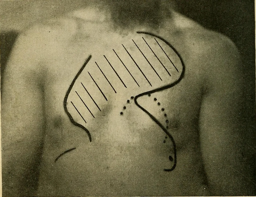 An illustration from The Roentgen rays in medicine and surgery as an aid in diagnosis and as a therapeutic agent : designed for the use of practitioners and students, 1901, leaf 333
