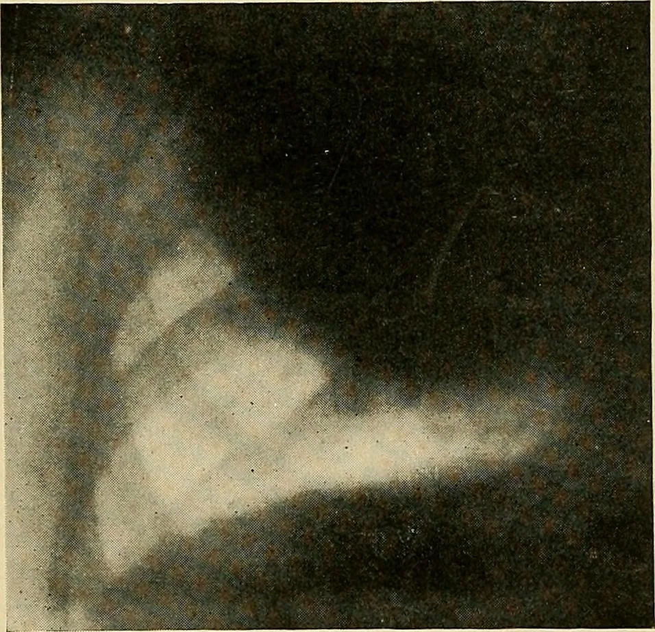 An illustration from The Roentgen rays in medicine and surgery as an aid in diagnosis and as a therapeutic agent : designed for the use of practitioners and students, 1901, leaf 356