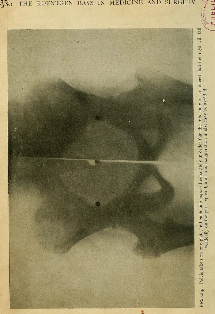 An illustration from The Roentgen rays in medicine and surgery as an aid in diagnosis and as a therapeutic agent : designed for the use of practitioners and students, 1901, leaf 399