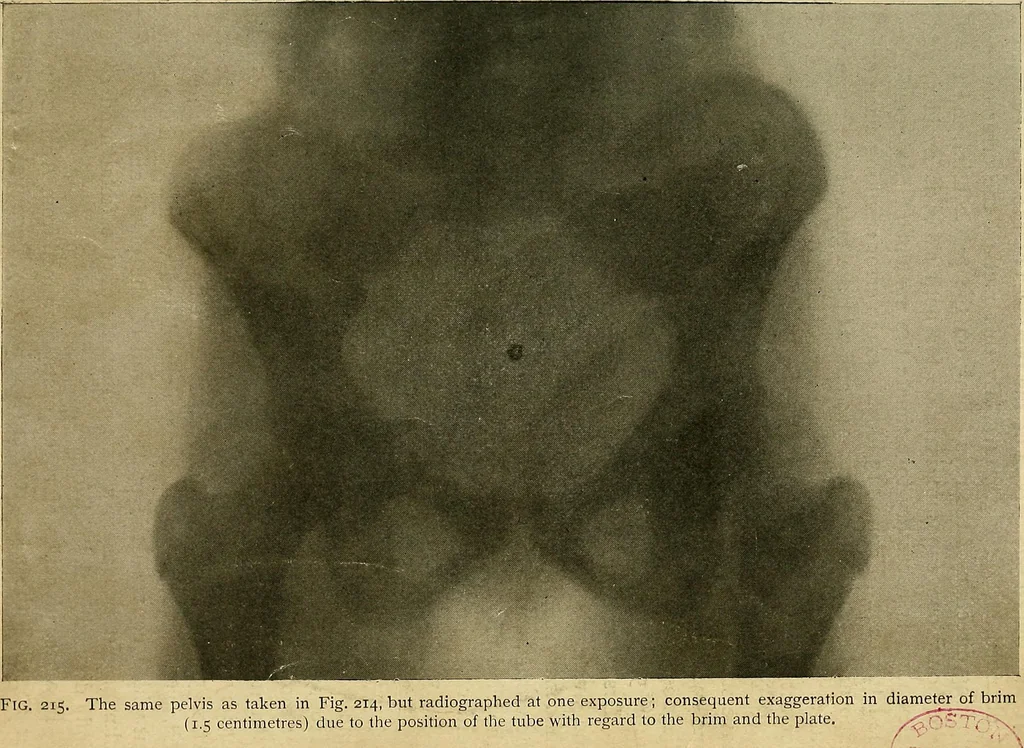 An illustration from The Roentgen rays in medicine and surgery as an aid in diagnosis and as a therapeutic agent : designed for the use of practitioners and students, 1901, leaf 400