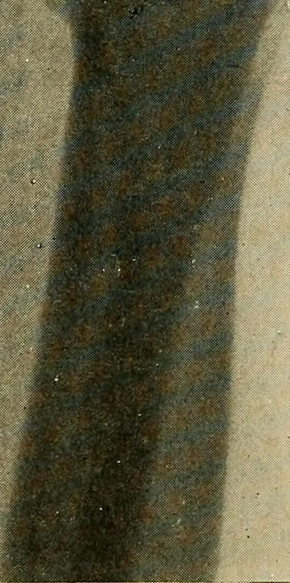 An illustration from The Roentgen rays in medicine and surgery as an aid in diagnosis and as a therapeutic agent : designed for the use of practitioners and students, 1901, leaf 405