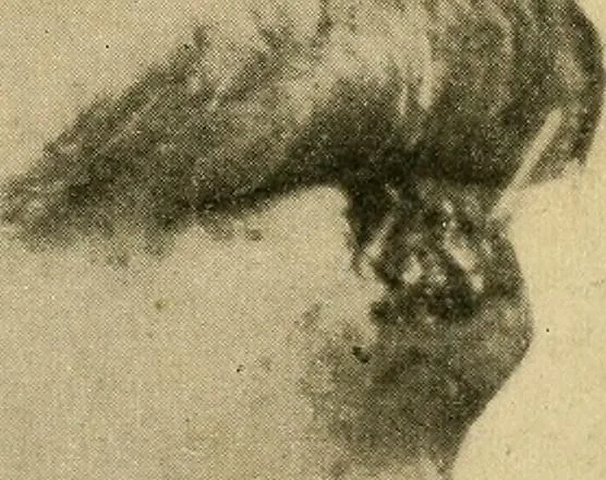 An illustration from The Roentgen rays in medicine and surgery as an aid in diagnosis and as a therapeutic agent : designed for the use of practitioners and students, 1901, leaf 442