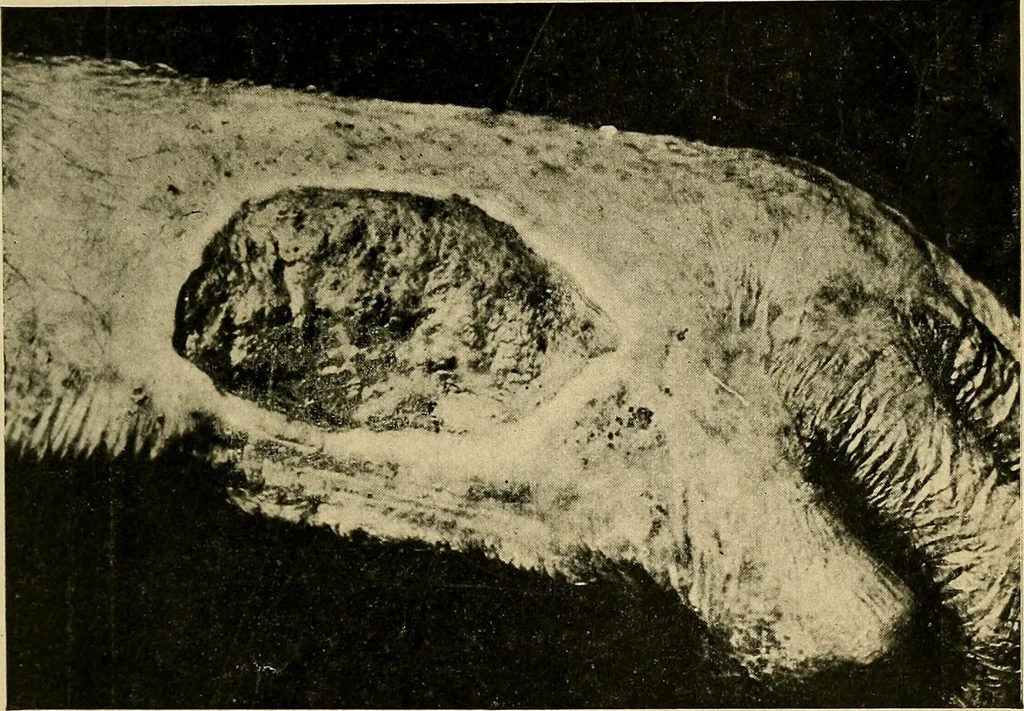 An illustration from The Roentgen rays in medicine and surgery as an aid in diagnosis and as a therapeutic agent : designed for the use of practitioners and students, 1901, leaf 454